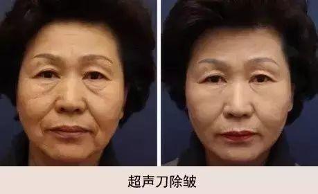 超声刀和热玛吉哪个提升效果好,超声刀和埋线提升哪个效果好