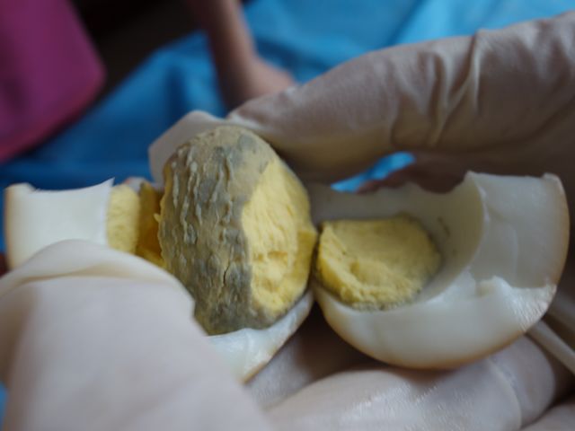 家喻户晓的“滚蛋疗法”真的能治病吗？看大家的反馈就知道了