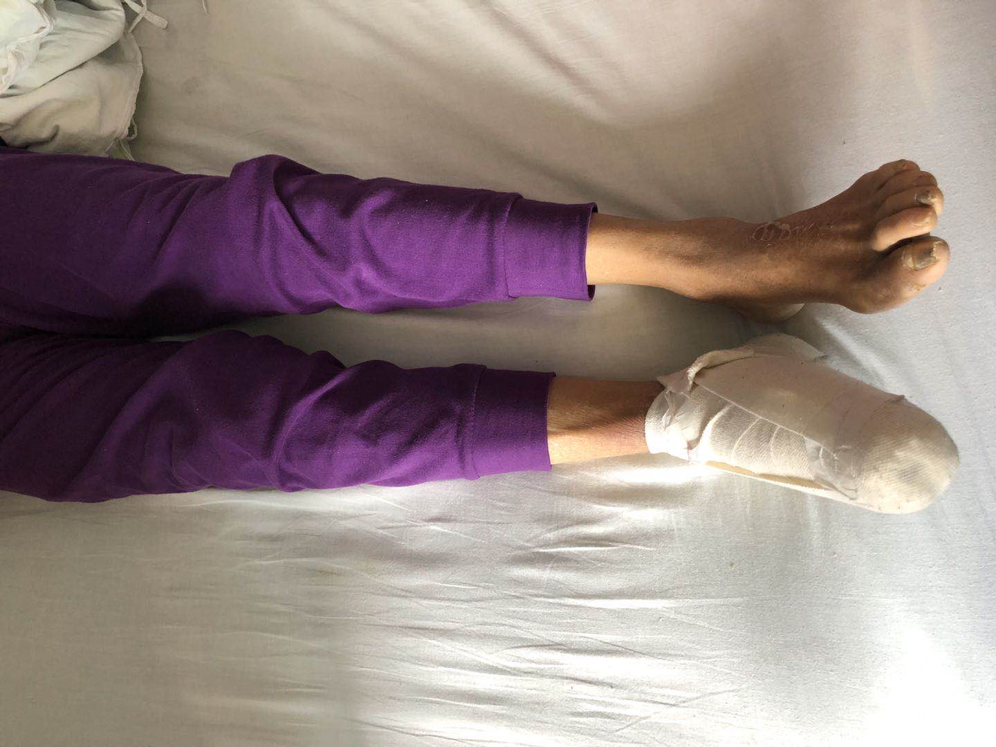 糖尿病老人烂脚趾一定要截肢吗,糖尿病老人脚上长水泡是怎么处理