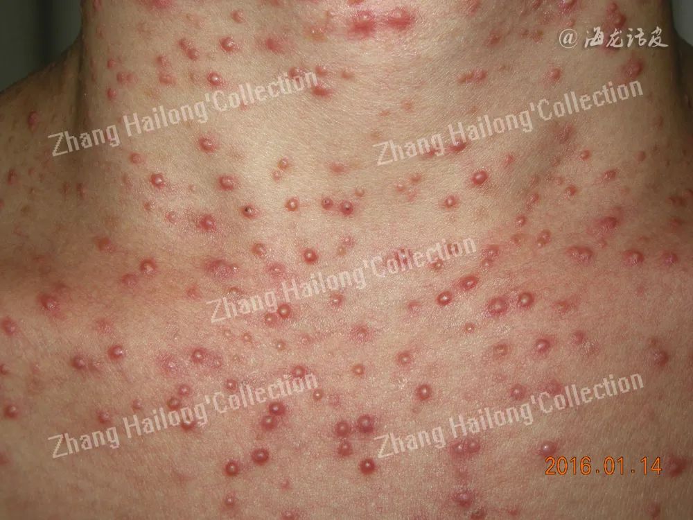 胸毛囊炎有红点,胸前长了很多马拉色菌毛囊炎