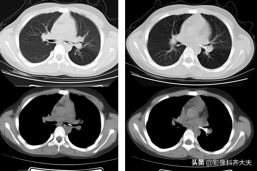 ct能查出气管微小异物嘛,气管异物ct怎么做