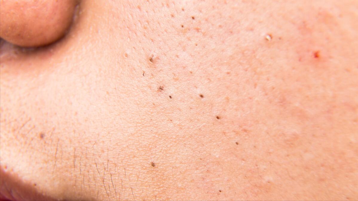 鼻子上挤出来的白色丝状物，看起来像一条虫子，是螨虫吗？