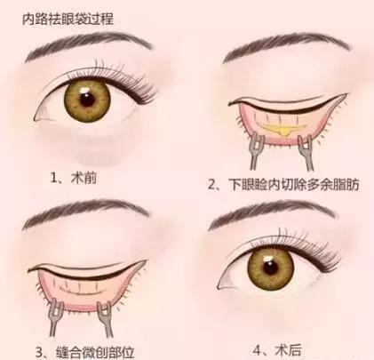 眼袋怎么消除简单方法男生,黑眼袋怎么消除最快方法男士