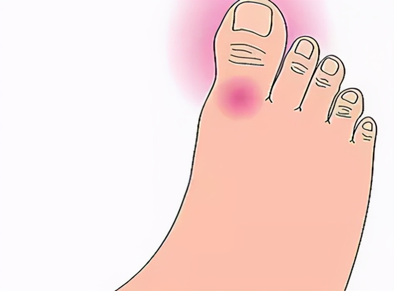 痛风怎么样才算彻底治愈,为了告别痛风要做到这四点