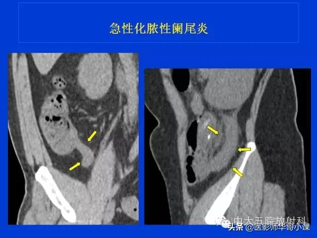 阑尾炎课件,阑尾炎的超声课件