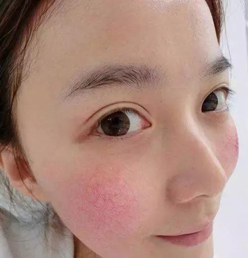 有效消除红血丝,修复红血丝最简单的方法