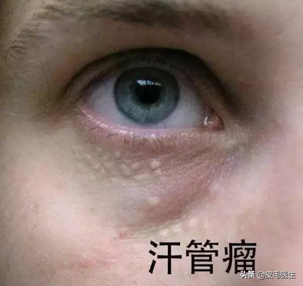 眼霜对眼睛周围小细纹管用吗,去眼上的脂肪颗粒哪一种眼霜好