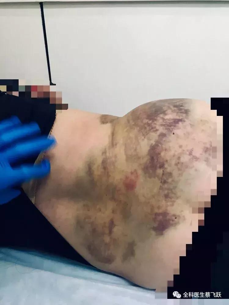 痛得像针扎火烧，她去看病，臀部反被“打”出一片淤伤…