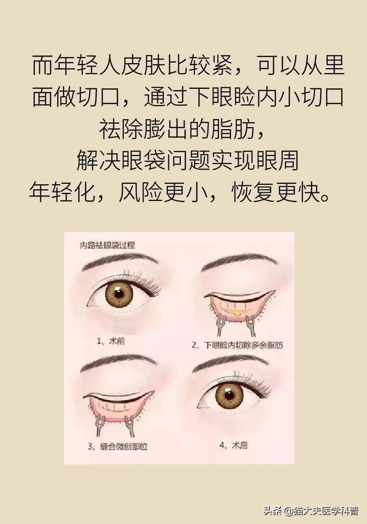 有眼袋怎么办五种去眼袋秘方,眼袋重最简单的去眼袋的方法