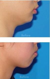 苹果肌下垂法令纹重用什么精华,vol.5