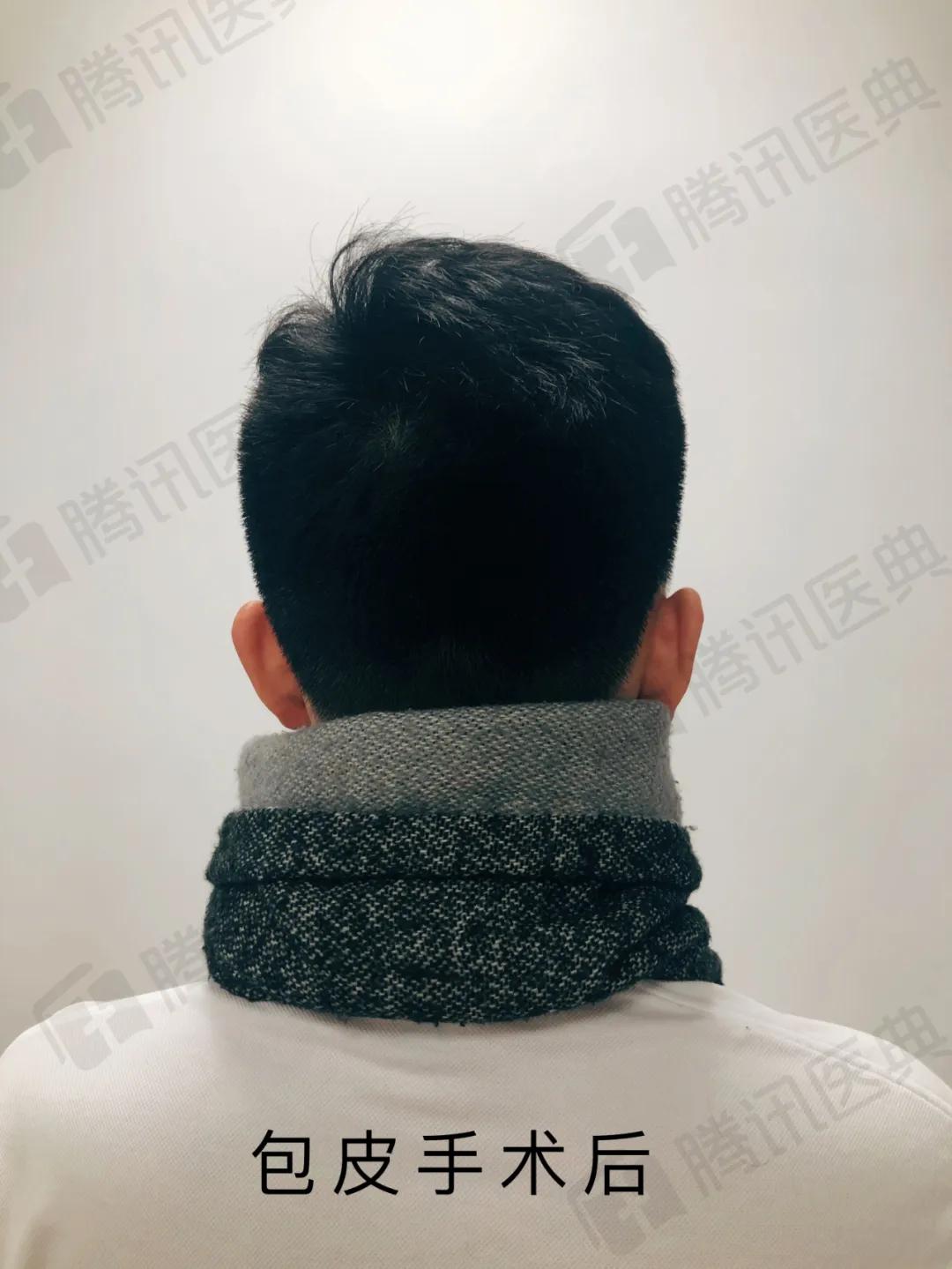 割包皮能解决系带短吗,割包皮能不能解决包皮嵌顿问题