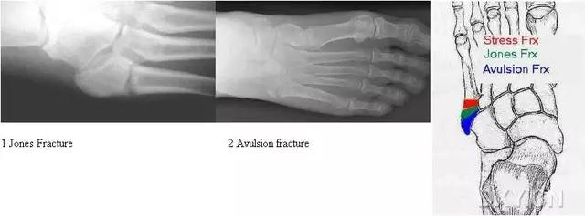 几种严重骨折医学名称,常见的骨折有哪些名称
