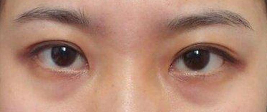 黑眼圈是不是熬夜熬的,有黑眼圈真是因为熬夜吗