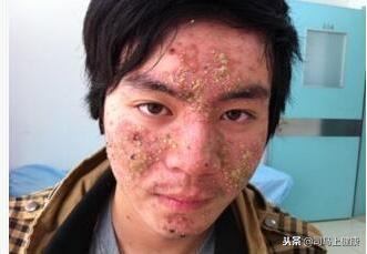 湿疹不可怕按一个穴位就可以解决,你还在为猫癣烦恼吗