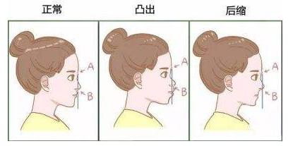 龅牙属于复杂正畸吗,整齐的龅牙是不是最好矫正的