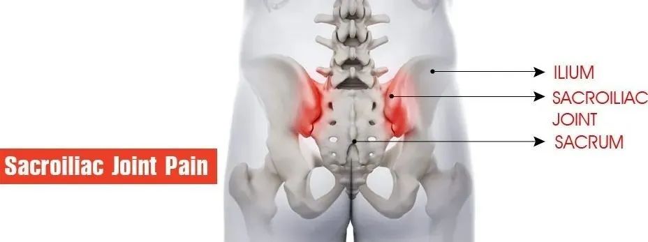 骶髂关节紊乱后复位后依然腰痛,运动康复腰椎酸痛