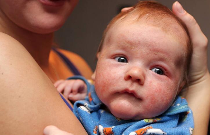 宝宝湿疹反反复复是咋回事,宝宝湿疹一直反复发作是什么原因