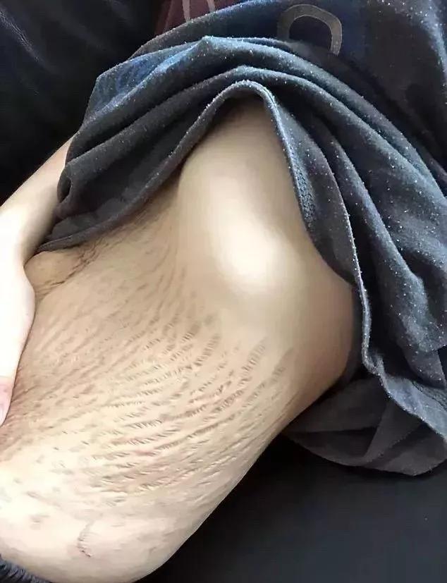 生完宝宝后脱肛肛裂咋办,孕中期脱肛肛裂