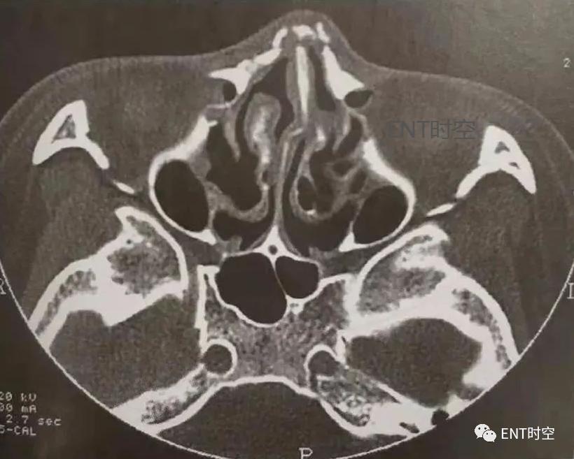 医学影像学解剖鼻骨,医学影像骨折