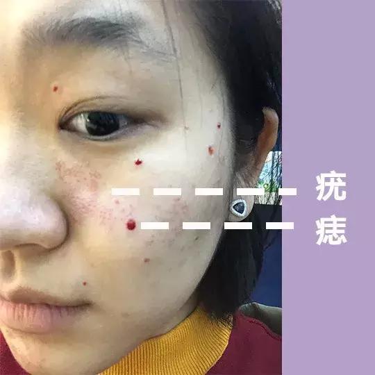 激光祛痣后悔吗,激光祛痣没掉反而更大