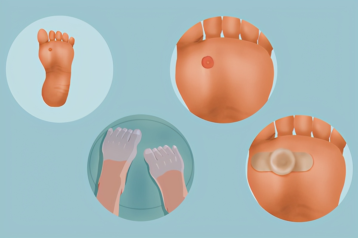 脚上长了很多鸡眼怎么解决,脚上长了鸡眼有什么办法处理断根