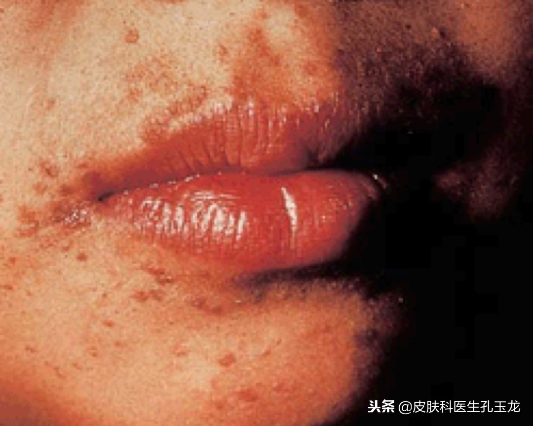 皮肤科疣有哪些,最常见的皮肤病扁平疣