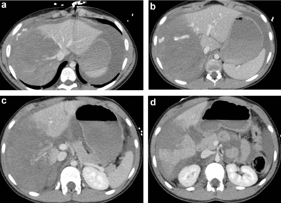 肝脏损伤的诊断和处理,肝脏损伤ii级