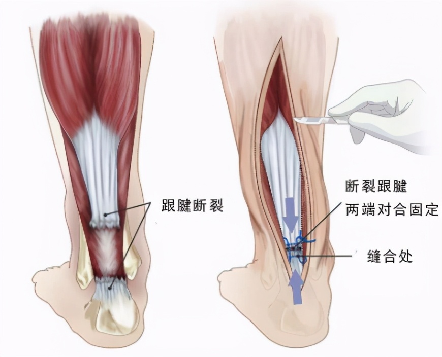 跟腱断裂微创手术能拄拐上班吗,跟腱断裂微创手术结实吗