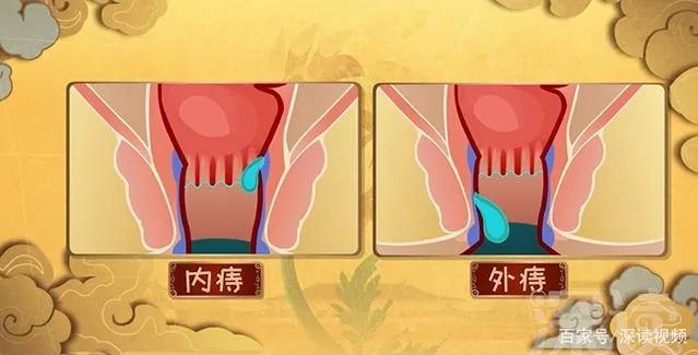 疼，很疼，真的很疼，疼得让你毛焦火乱肛肠病