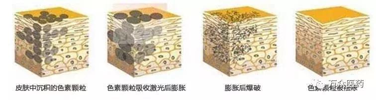 怎么预防老年斑和祛除老年斑,如何治疗手上长老年斑