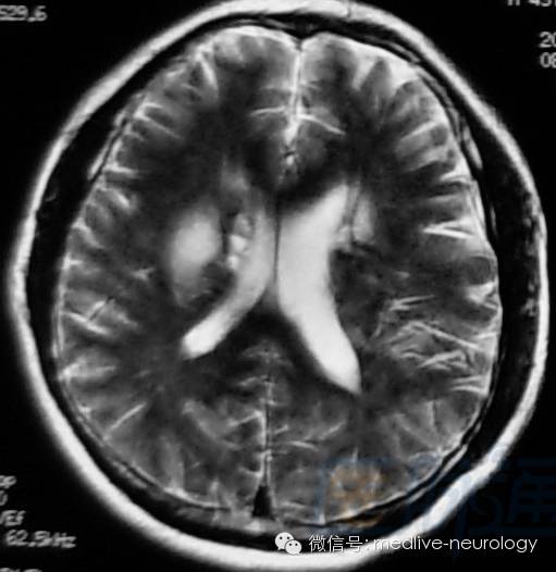 脑出血磁共振t1t2表现,10分钟记住脑出血核磁表现
