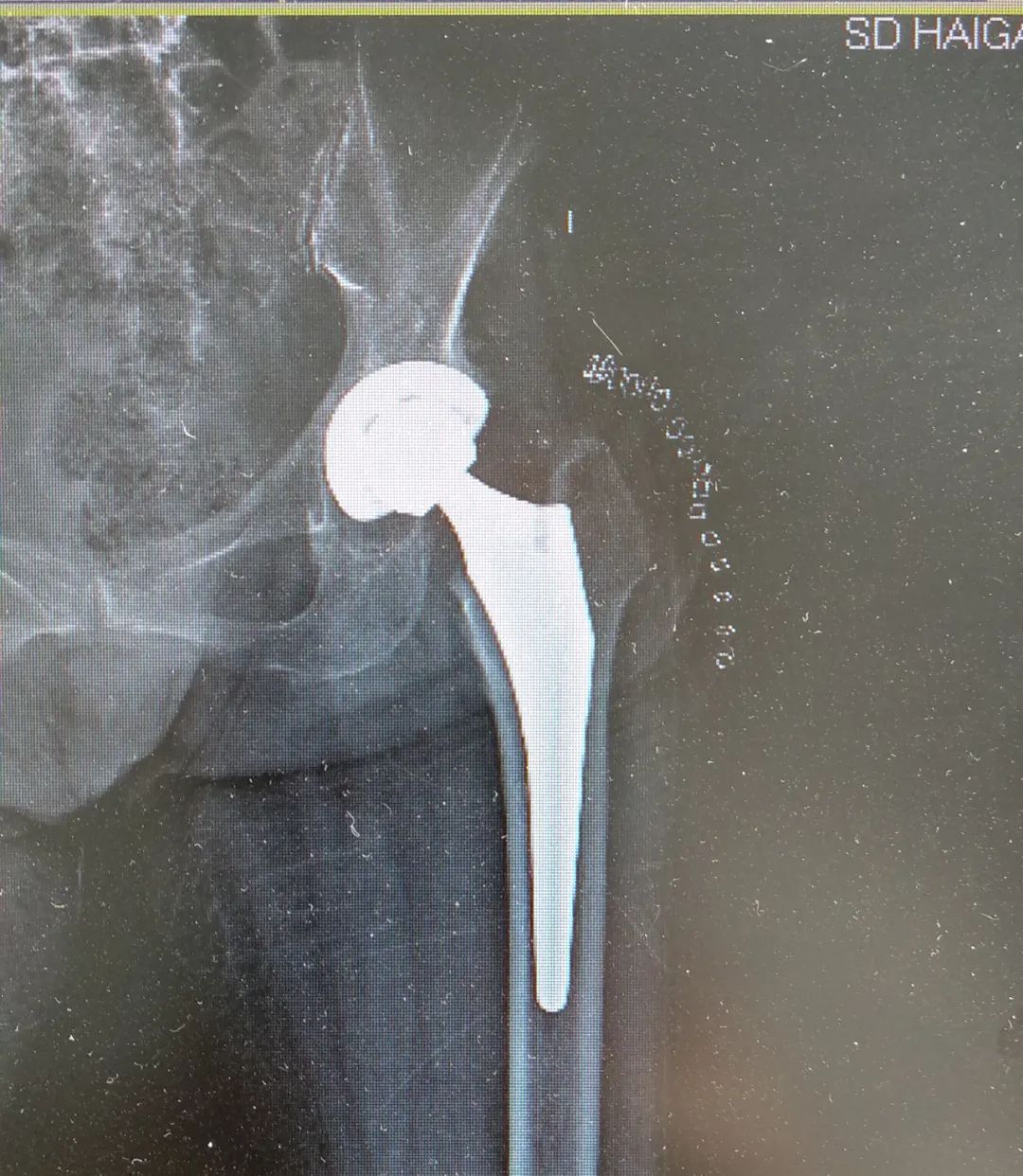 国内全髋关节置换最好的医生,微创全髋关节置换手术与传统置换