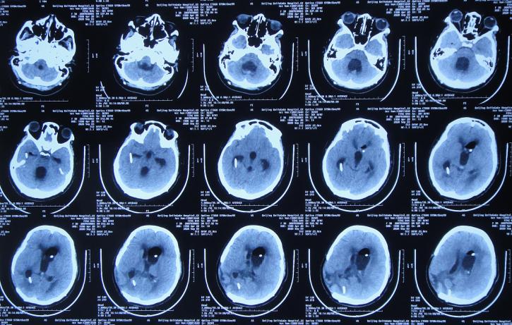 脑室有粘连脑积水有什么办法,脑动脉畸形手术后出现急性脑积水