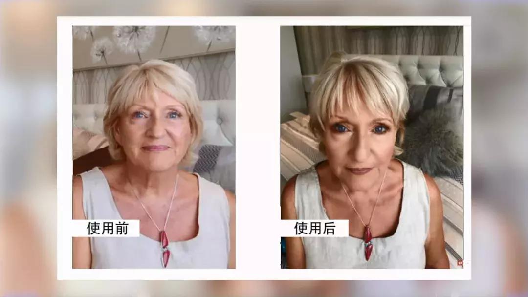 护肤黑科技顶级医美,用黑科技去除眼袋肿了十天