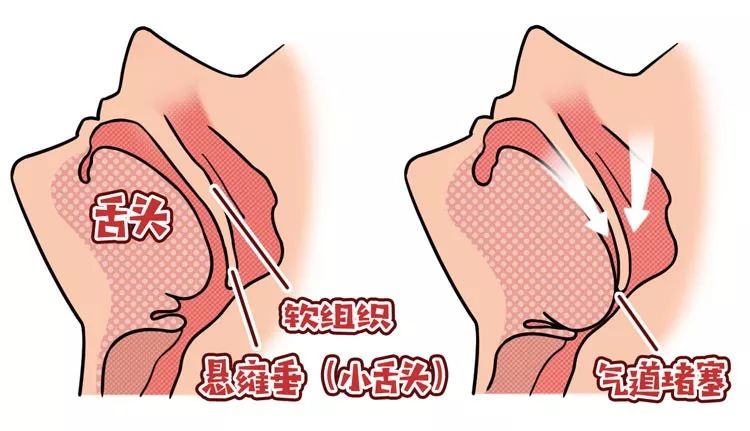 舍友打呼让他听啥歌,舍友打呼怎么解决