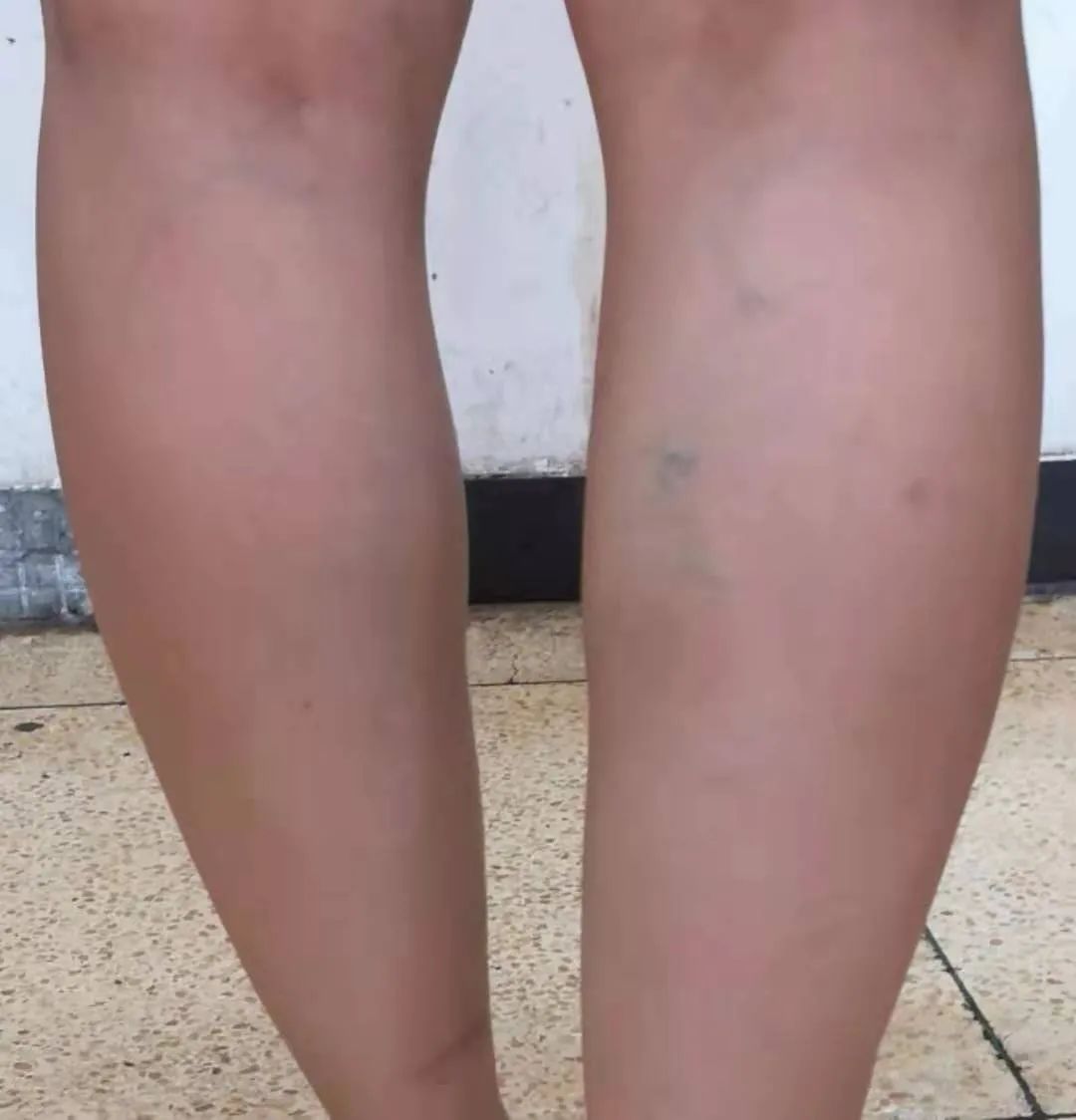 医用长款弹力袜如何穿才正确,医用弹力袜正确穿脱和清洗方法