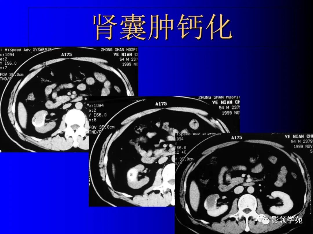 肾脏囊性肿块的影像学特点,肾脏典型病理图片及解析