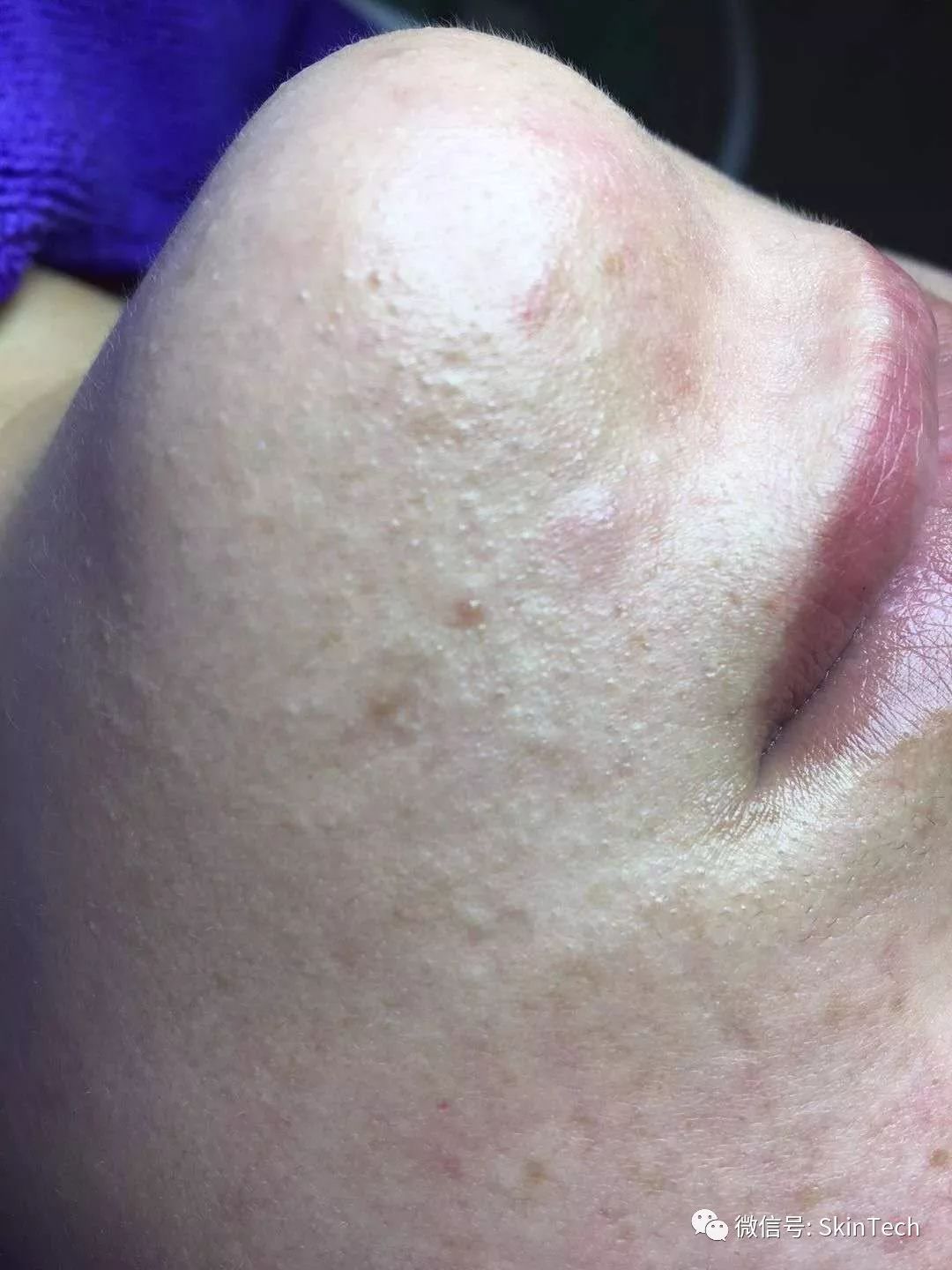 辟谣逆光疹,逆光疹是伪概念吗