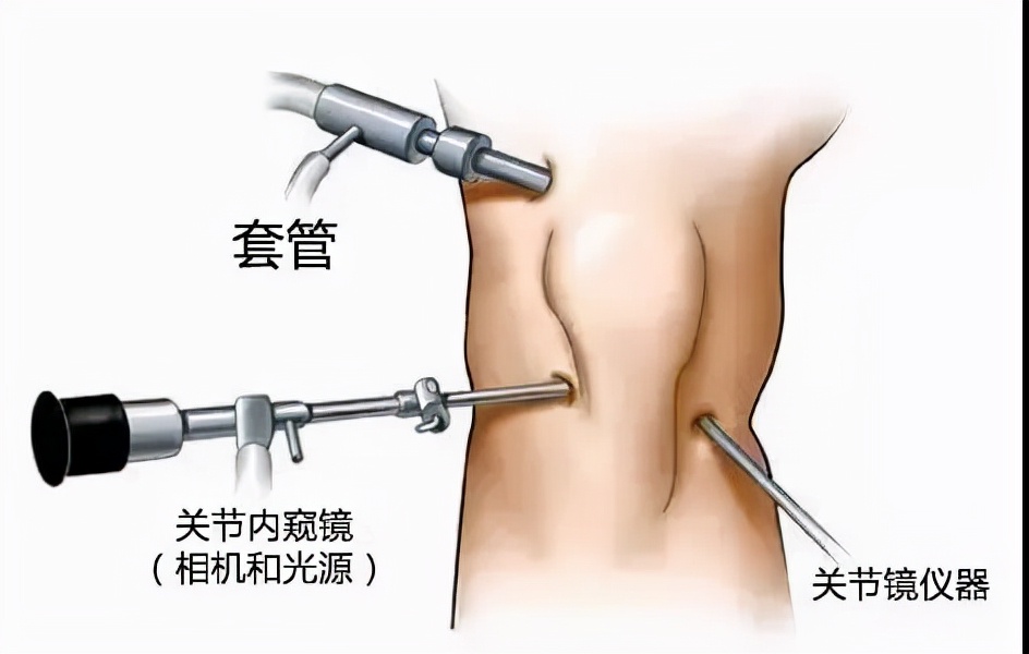 关节镜的适应症是什么,关节镜操作流程及注意事项