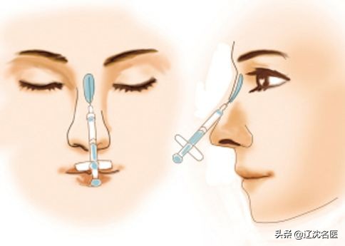 注射玻尿酸美容整形,微整形玻尿酸注射方法图解