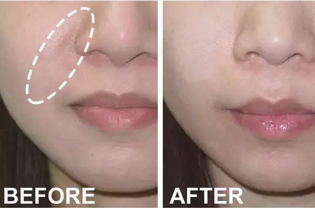 硬刚女皇龙妈也扛不住法令纹,2条沟壑让人心疼,贴一贴就消了