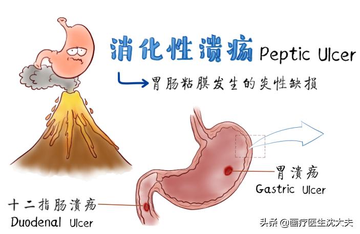 胃溃疡的原理动画,胃溃疡的原因动画演示