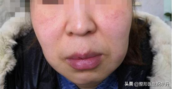 法令纹凸显怎么办,胖起来泪沟和法令纹会减轻吗