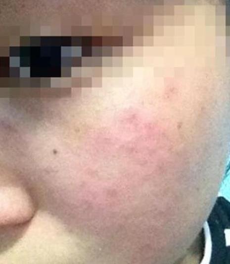 儿童脸上突然过敏红肿图片,五岁孩子脸皮肤红肿发痒