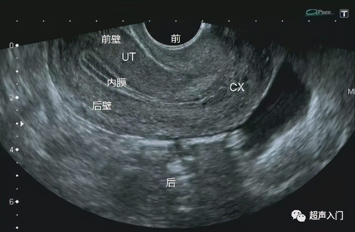 超声怎么分辨前后位子宫,超声如何区分子宫前后位