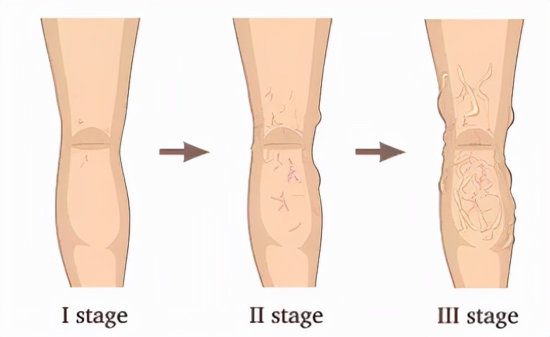 怎么判断自己得了静脉曲张,如何自行判断是否得上静脉曲张