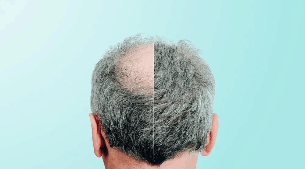 头屑多头发又掉是缺什么,头皮掉大块头屑是要秃头了吗