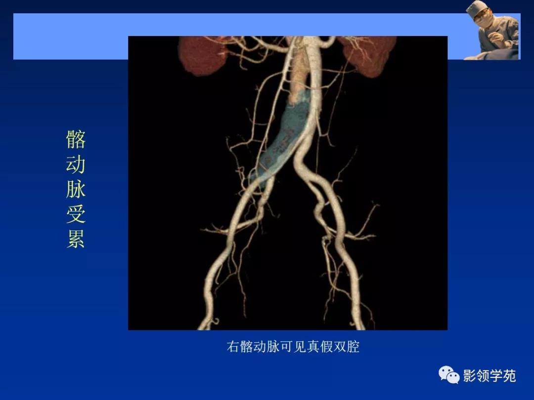 主动脉夹层壁间血肿如何鉴别,主动脉夹层血肿溃疡