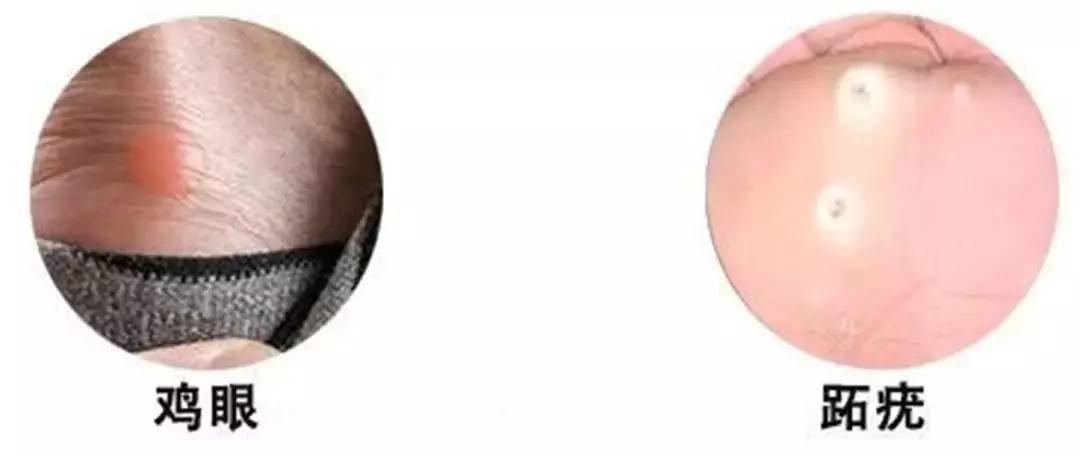 鸡眼贴可以把跖疣去掉吗,怎么判断是鸡眼还是跖疣