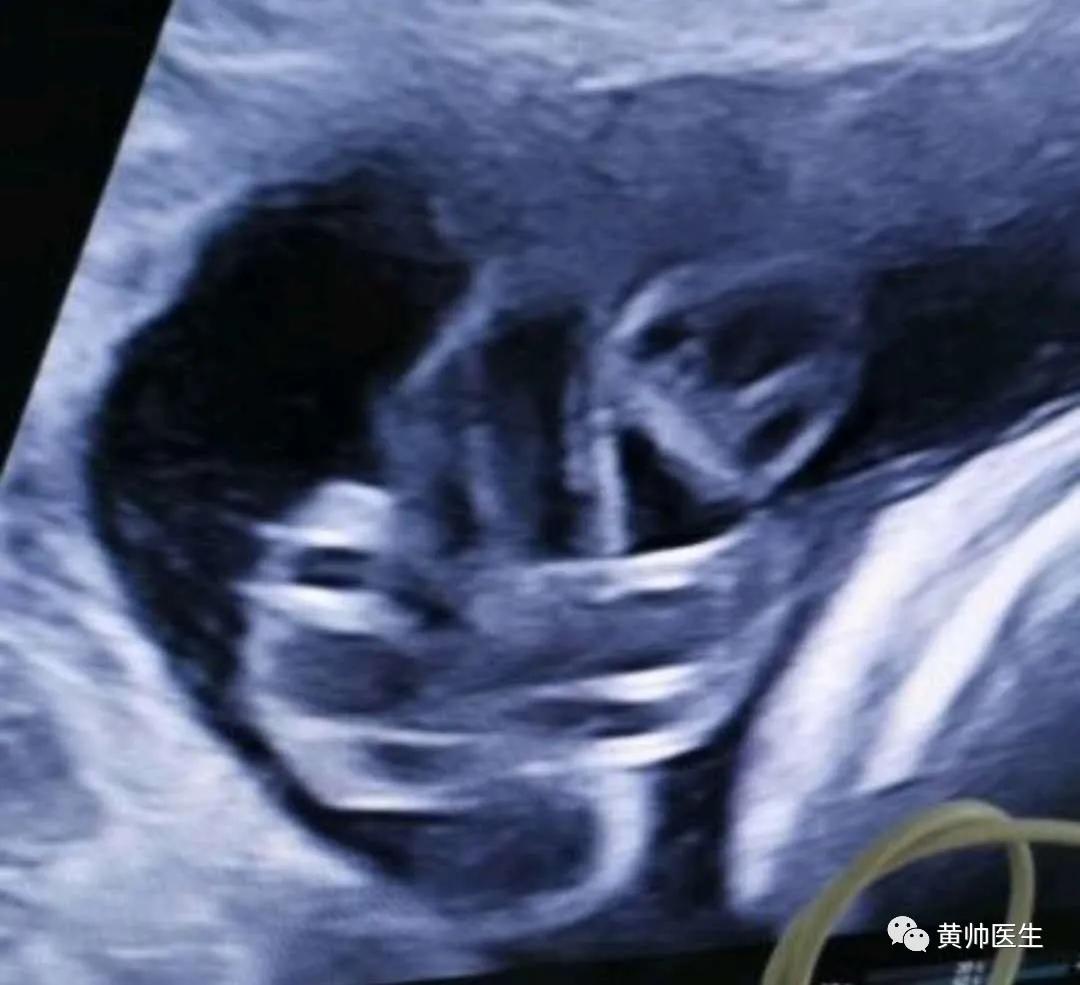 脐带疑似打结,脐带打结科普视频